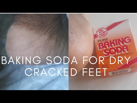 How To Remove Dry, Dead and Cracked Skin From Feet At Home| DIY| Using Baking Soda